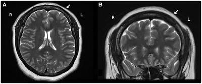 Successful Treatment of a Drug-Resistant Epilepsy by Long-term Transcranial Direct Current Stimulation: A Case Report